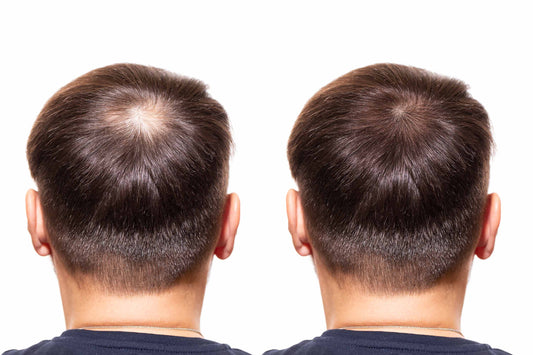 Proven ways for hair regrowth in male and female baldness